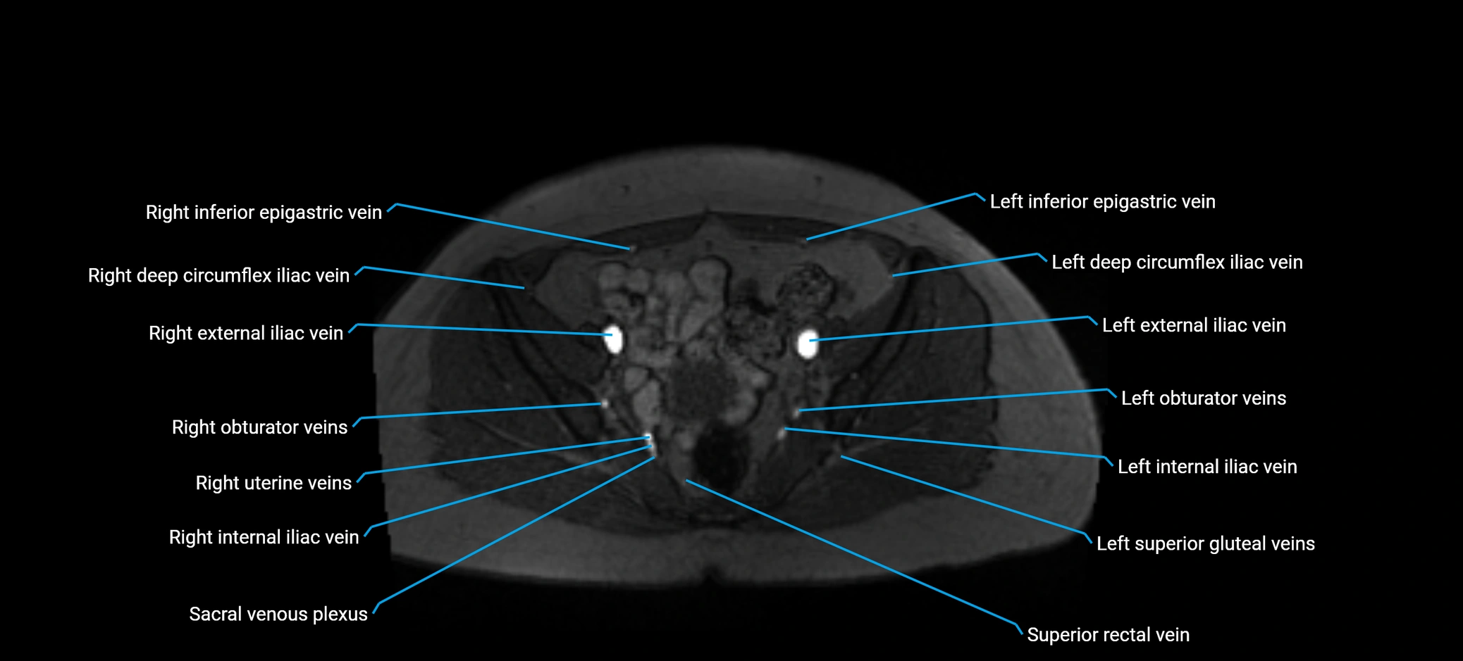 MRV abdomen pelvis & lower limb axial cross sectional anatomy labelled MRI image 153 (1).webp
